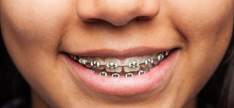 Nie jest prawdą, że aparat ortodontyczny sam w sobie może być przyczyną pogorszenia się stanu naszego uzębienia. Natomiast prawdą jest, że osoby noszące aparat ortodontyczny muszą w szczególnym stopniu dbać o higienę jamy ustnej.